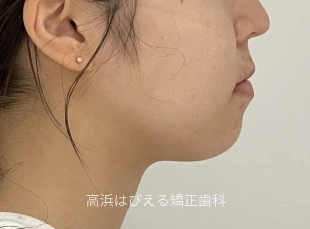 18歳女性の受け口（切端咬合）症例の治療前の横顔写真