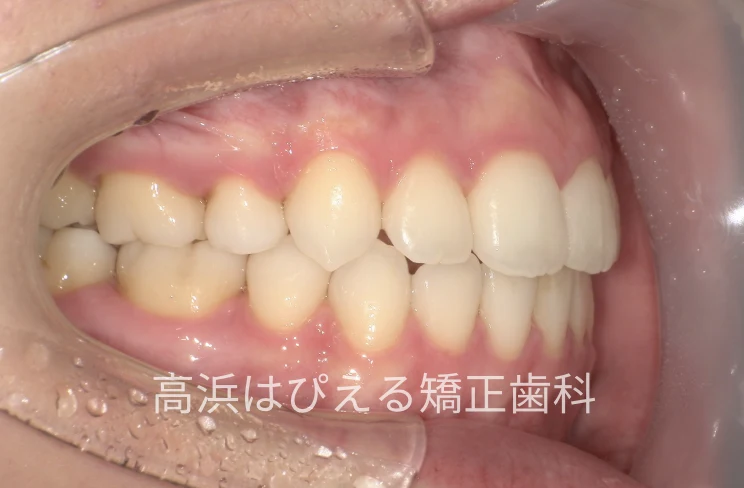 18歳女性の切端咬合・正中のズレ症例の治療後の右側面口腔内写真