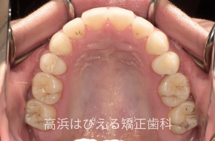 18歳女性の受け口（切端咬合）症例の治療後の上顎咬合面口腔内写真