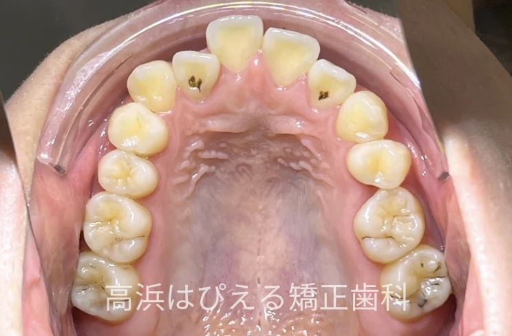 18歳女性の受け口（切端咬合）症例の治療前の上顎咬合面口腔内写真
