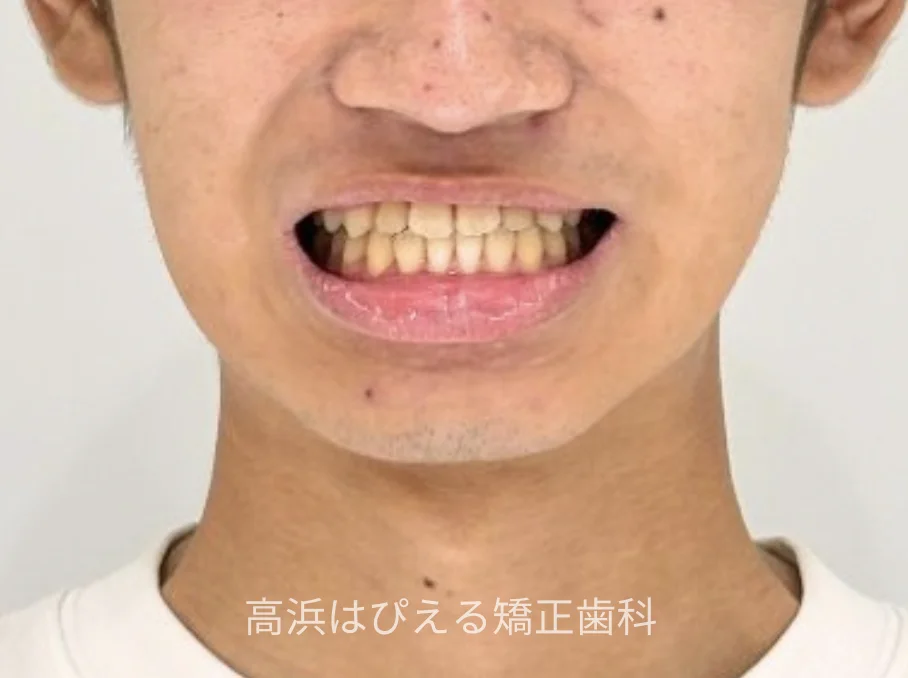 10代男性の受け口症例の治療後の正面顔貌写真