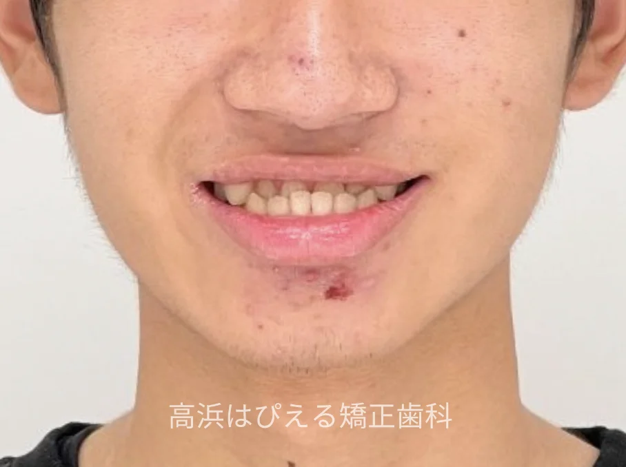 10代男性の受け口症例の治療前の正面顔貌写真