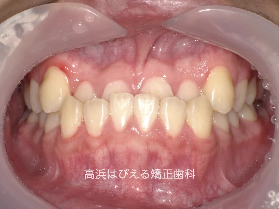 10代男性の受け口症例の治療前の正面口腔内写真