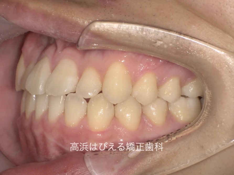 10代男性の受け口症例の治療後の左側面口腔内写真