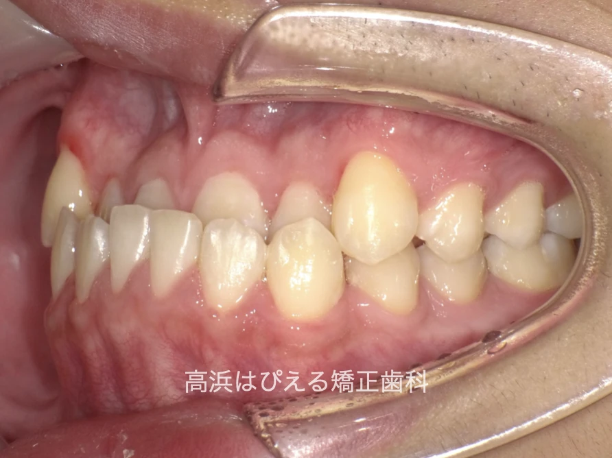 10代男性の受け口症例の治療前の左側面口腔内写真