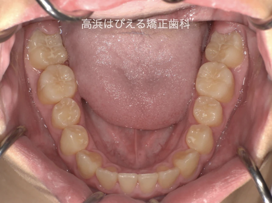 10代男性の受け口症例の治療後の下顎咬合面写真