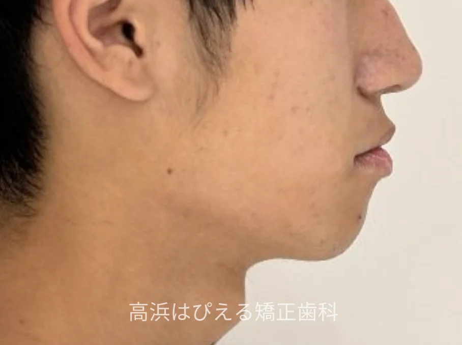 10代男性の受け口症例の治療後の横顔写真
