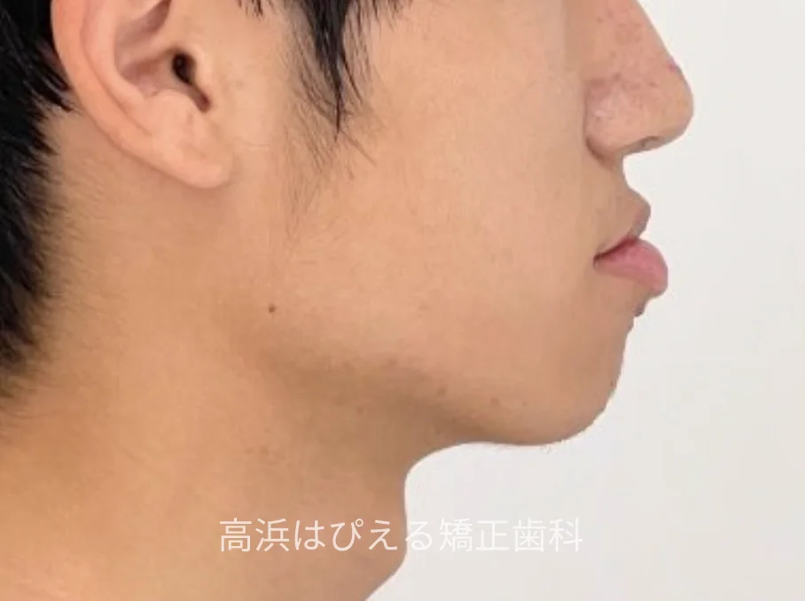 10代男性の受け口症例の治療前の横顔写真