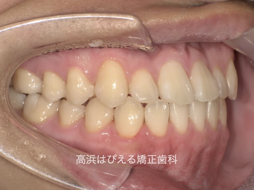10代男性の受け口症例の治療後の右側面口腔内写真