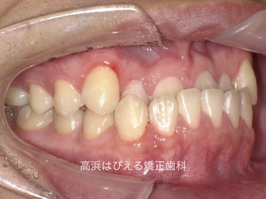 10代男性の受け口症例の治療前の右側面口腔内写真