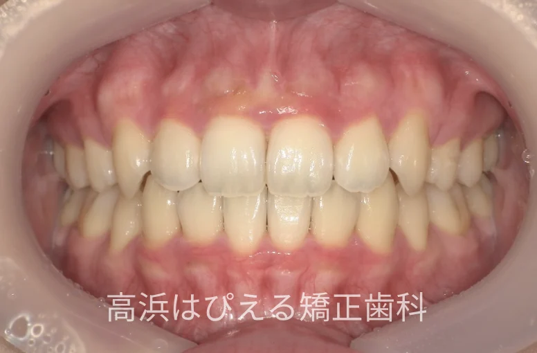 22歳女性の八重歯・正中のズレの治療後の正面口腔内写真