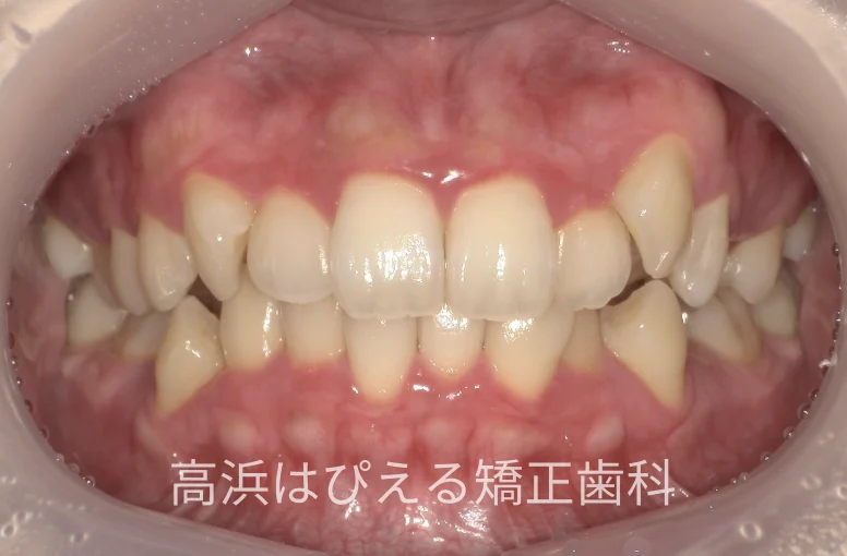 22歳女性の八重歯・正中のズレの治療前の正面口腔内写真