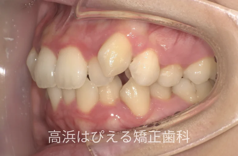22歳女性の八重歯・正中のズレの症例の治療前の左側面口腔内写真