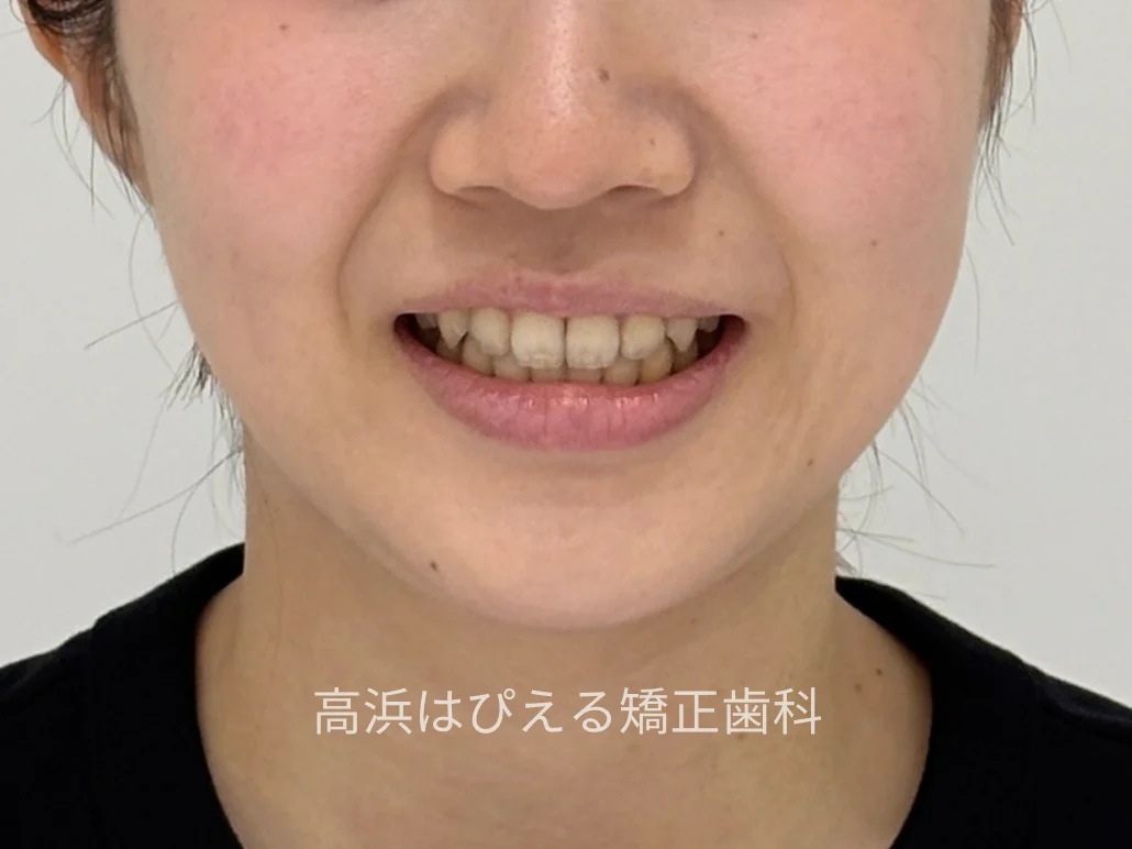 22歳女性の八重歯・正中のズレの症例の治療後の口元写真