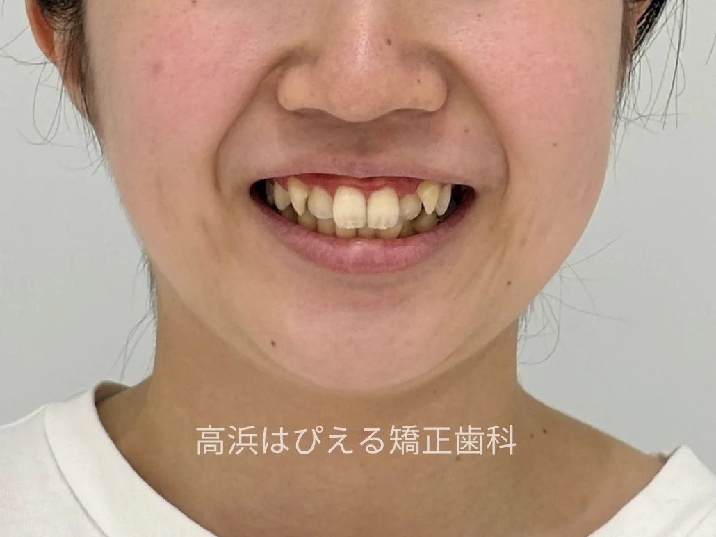 22歳女性の八重歯・正中のズレの症例の治療前の口元写真