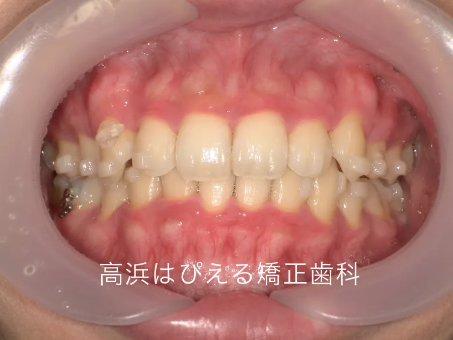 22歳女性の八重歯・正中のズレの症例の治療開始から約1年時点の正面口腔内写真