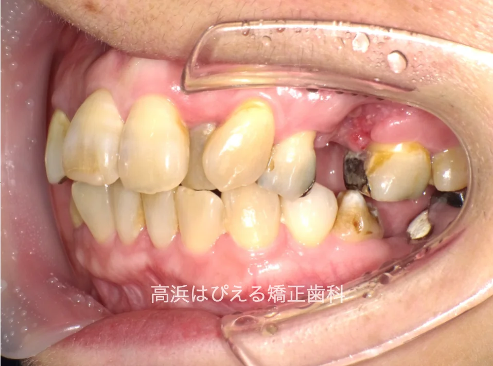 50代女性の虫歯で失った歯・ガタガタの治療前の左側面口腔内写真