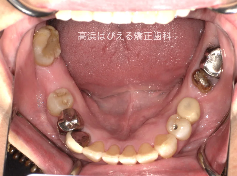 50代女性の虫歯で失った歯・ガタガタの治療後の下顎咬合面口腔内写真