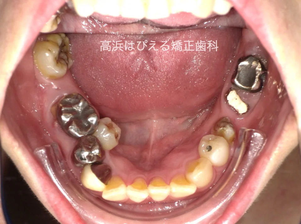 50代女性の虫歯で失った歯・ガタガタの治療前の下顎咬合面口腔内写真