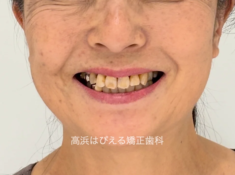 50代女性の虫歯で失った歯・ガタガタの治療後の口元写真