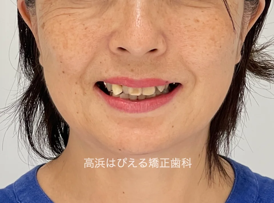 50代女性の虫歯で失った歯・ガタガタの治療前の口元写真