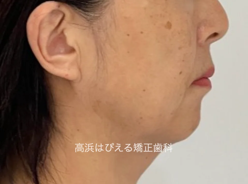 50代女性の虫歯で失った歯・ガタガタの治療後の横顔写真