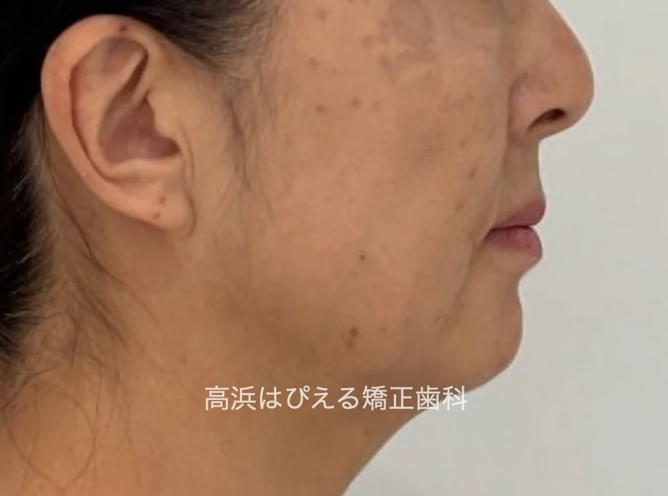 50代女性の虫歯で失った歯・ガタガタの治療前の横顔写真