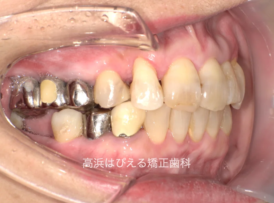 50代女性の虫歯で失った歯・ガタガタの治療後の右側面口腔内写真