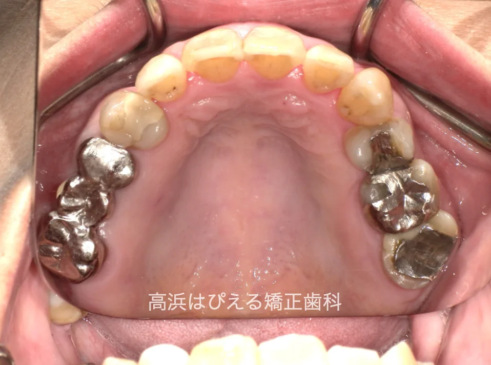 50代女性の虫歯で失った歯・ガタガタの治療後の上顎咬合面口腔内写真