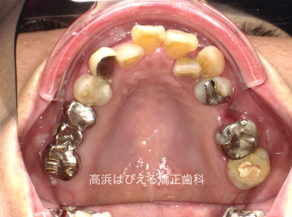 50代女性の虫歯で失った歯・ガタガタの治療前の上顎咬合面口腔内写真