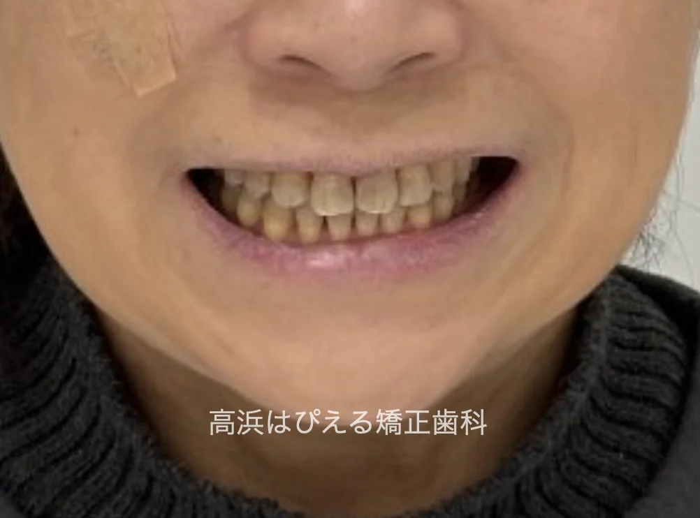 50代女性のガタガタ・過蓋咬合の治療後の口元写真