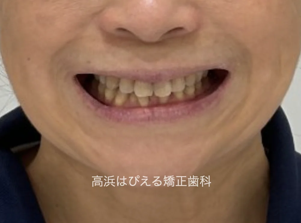50代女性のガタガタ・過蓋咬合の治療前の口元写真