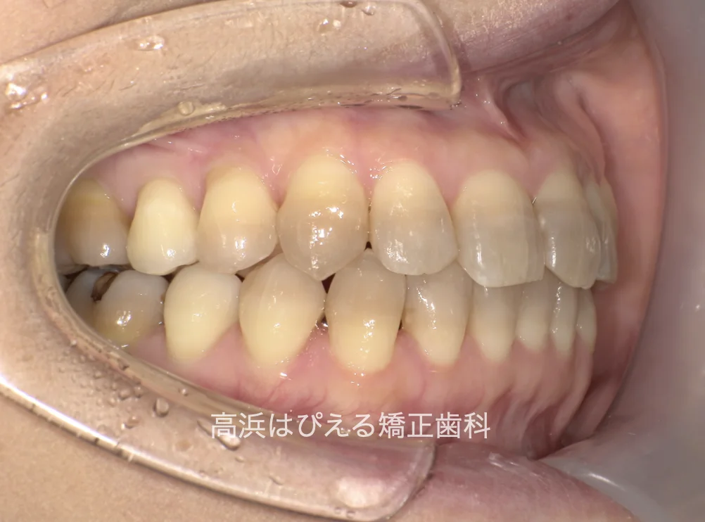 50代女性のガタガタ・過蓋咬合の治療後の右側面口腔内写真