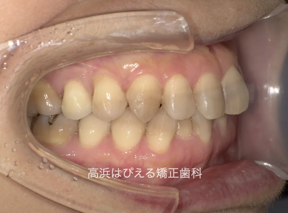 50代女性のガタガタ・過蓋咬合の治療前の右側面口腔内写真