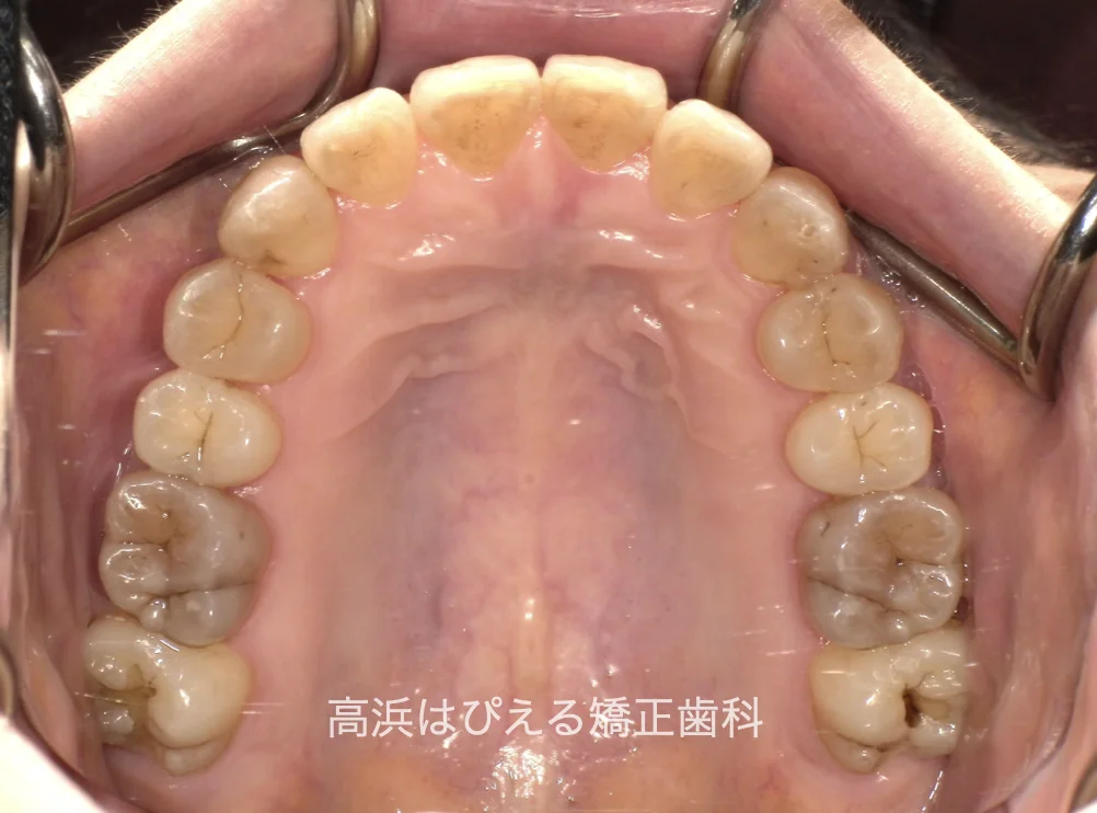 50代女性のガタガタ・過蓋咬合の治療後の上顎咬合面口腔内写真