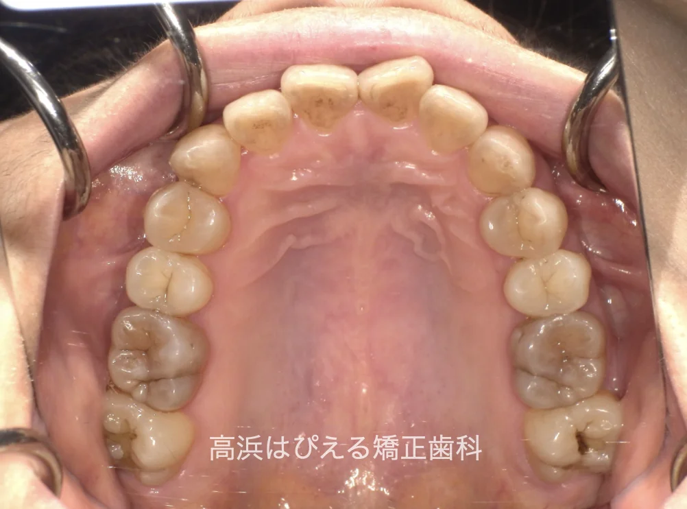 50代女性のガタガタ・過蓋咬合の治療前の上顎咬合面口腔内写真
