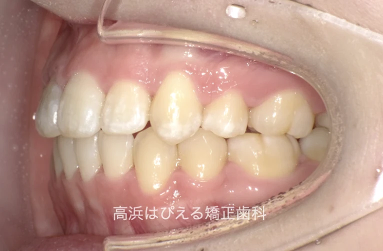16歳女子の出っ歯・ガタガタの治療後の左側面口腔内写真