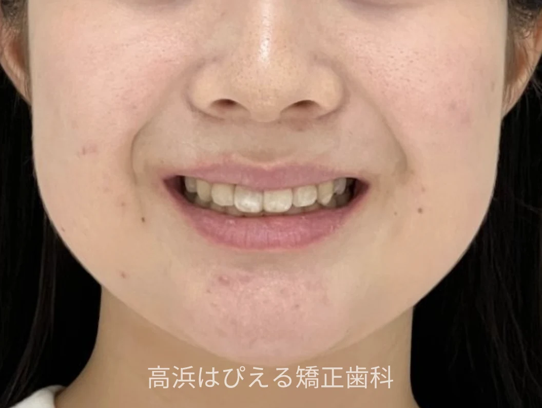 16歳女子の出っ歯・ガタガタの治療後の口元写真