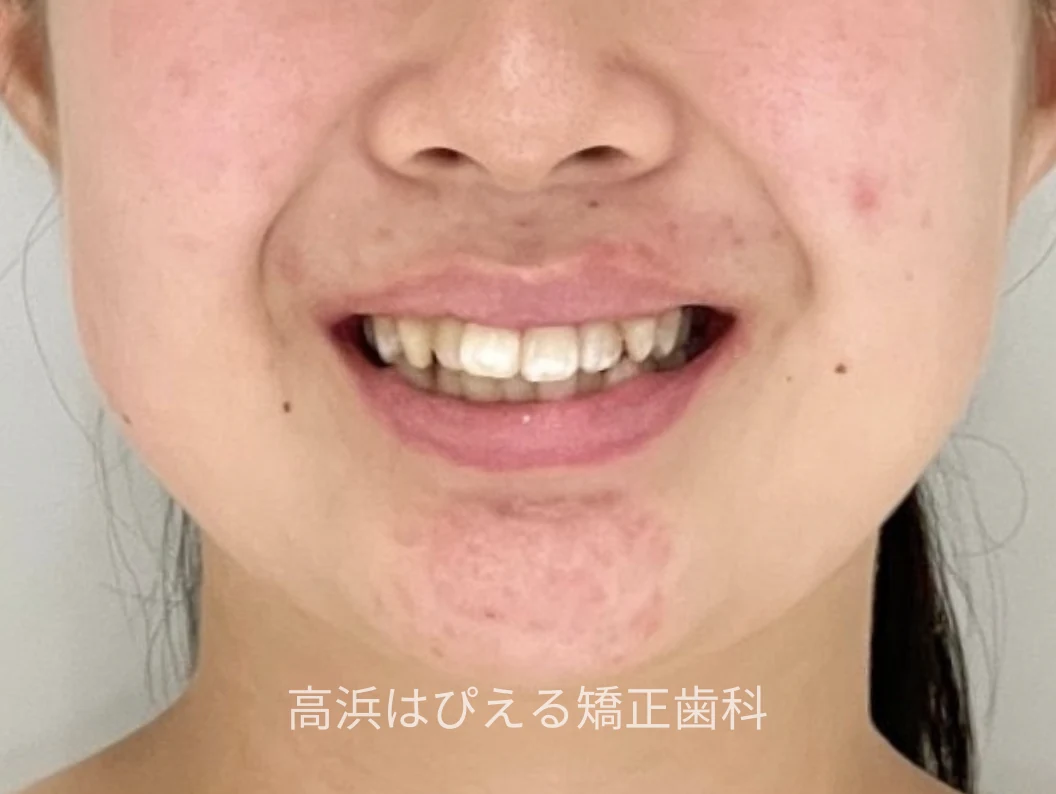 16歳女子の出っ歯・ガタガタの治療前の口元写真