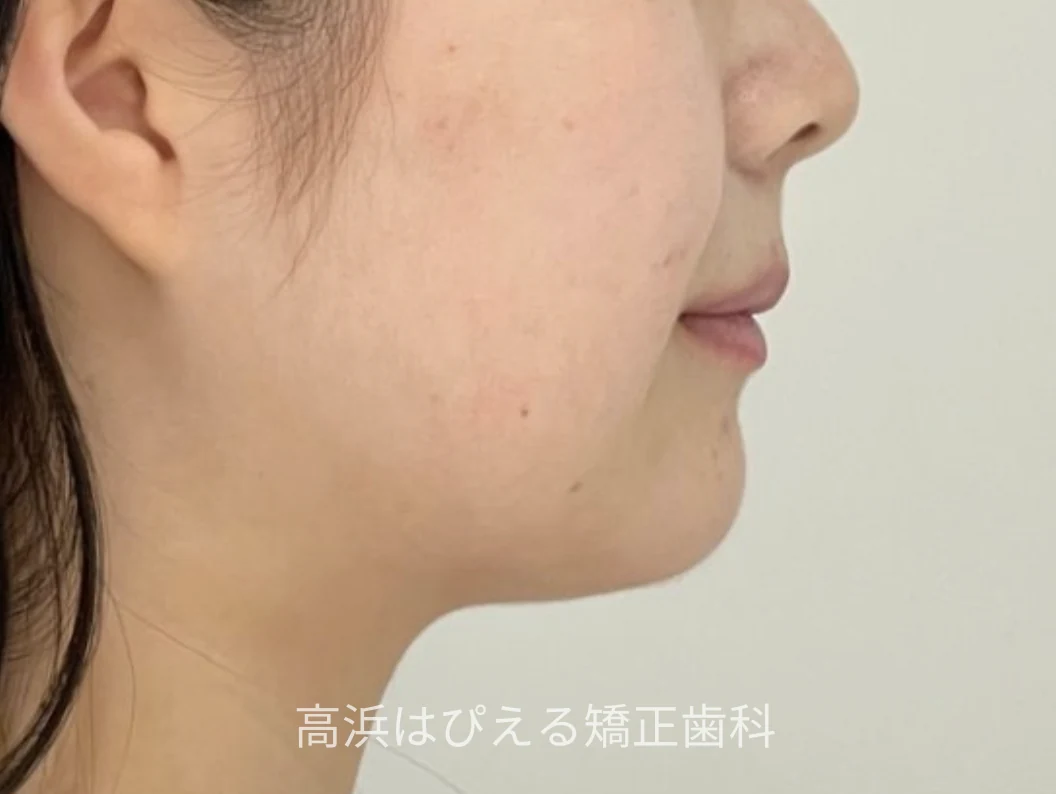 16歳女子の出っ歯・ガタガタの治療後の横顔写真