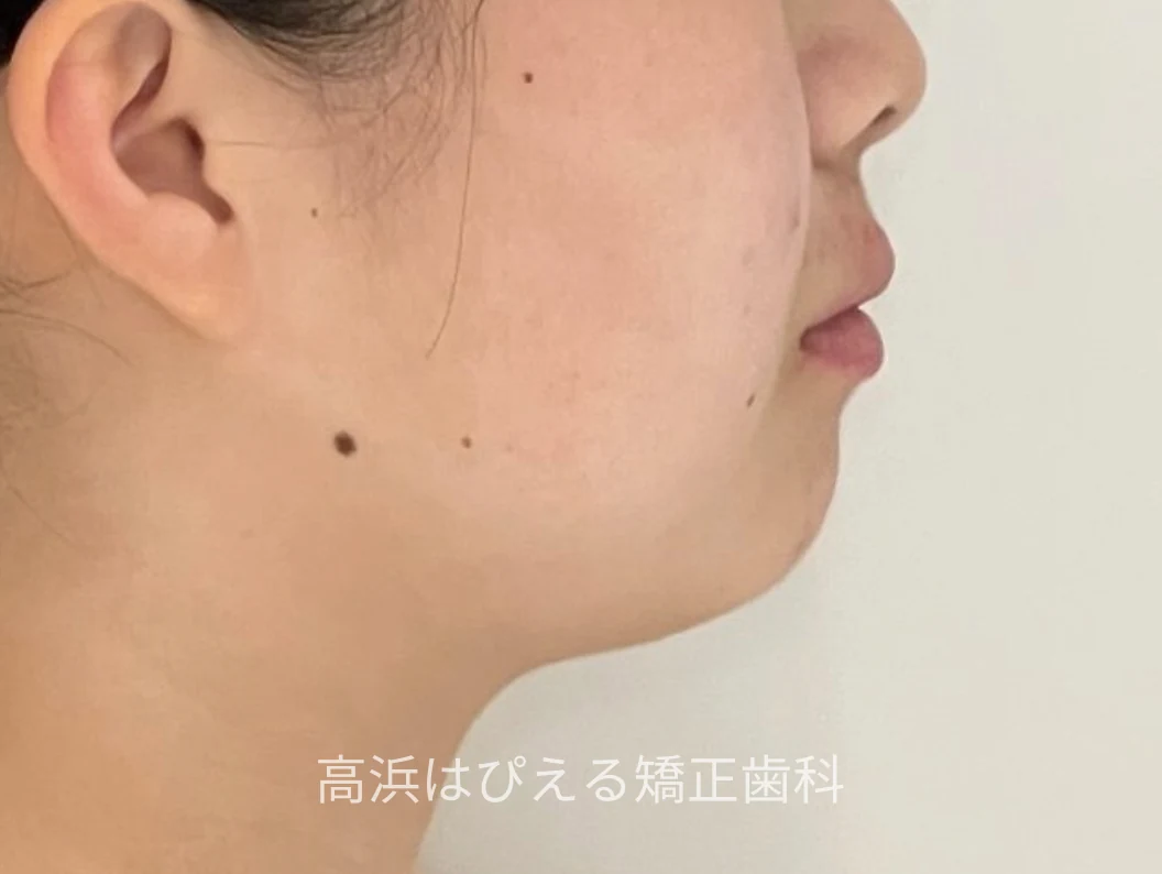 16歳女子の出っ歯・ガタガタの治療前の横顔写真