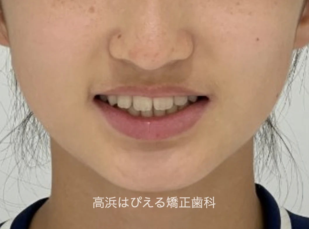 10歳女児の八重歯・ガタガタの治療後の口元（正面）写真
