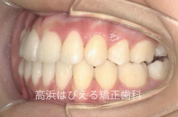 八重歯・ガタガタ症例の治療後の左側面口腔内写真