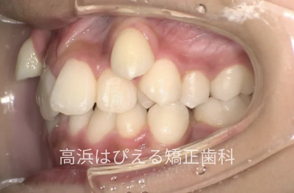 八重歯・ガタガタ症例の治療前の左側面口腔内写真