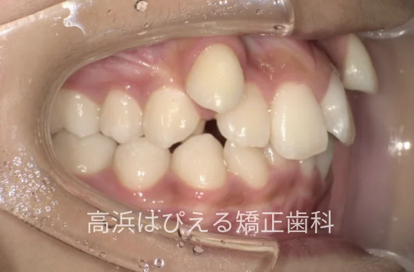 八重歯・ガタガタ症例の治療前の右側面口腔内写真